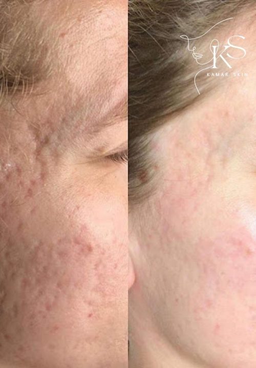Gesichtsbehandlung Kamar Skin Wuppertal