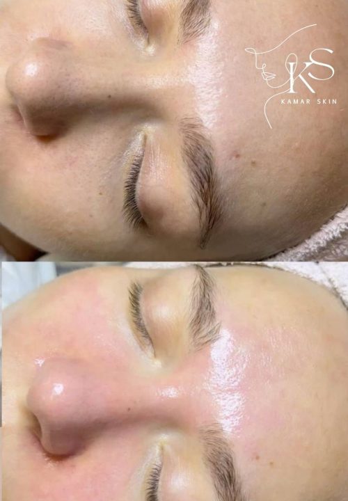 Gesichtsbehandlung Kamar Skin Wuppertal