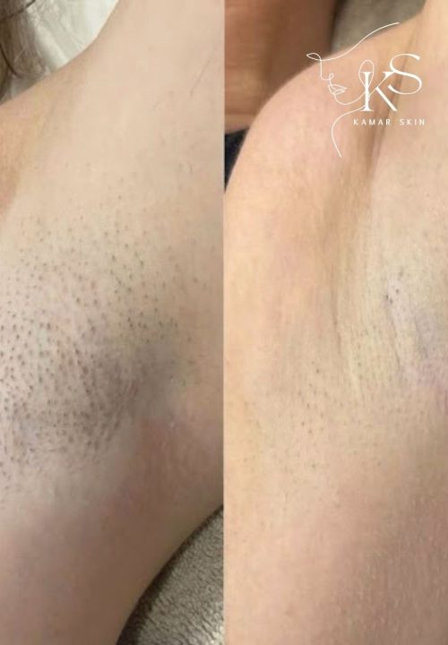 Epilation
